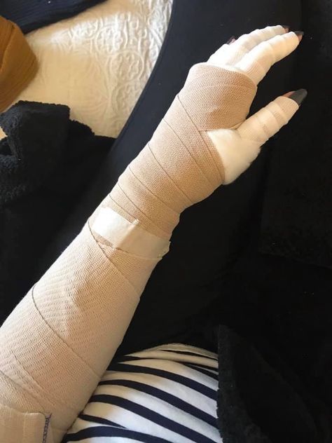 At the end of January 2019 I had a freak accident & shattered my elbow & dislocated my shoulder. #brokenelbow #rehabilitation #recovery Arm Fracture Snapchat, Hand Plaster Fracture, Broken Elbow, Selena Gomez Photoshoot, Snap Streak Ideas Easy, Broken Arm, Hospital Photos, Beach At Night, Insta Profile Pic