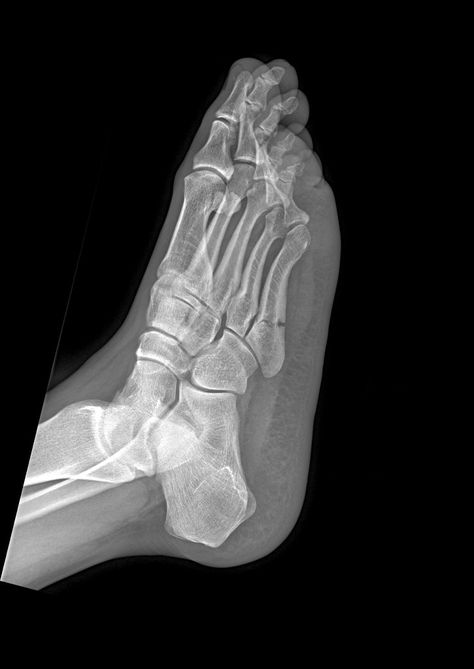 A Jones fracture is an extra-articular fracture at the base of the fifth metatarsal.  Jones fracture is located at the metadiaphyseal junction, approximately 2 cm (1.5-3 cm) from the tip of the 5th metatarsal, and has a predominantly horizontal course. It should not extend distally, nor should it extend to involve the articular surfaces. Leg Xray, Jones Fracture, Avulsion Fracture, The Skeletal System, Radiology Student, Radiology Imaging, Radiology Tech, X Ray Tech, Radiology Technologist