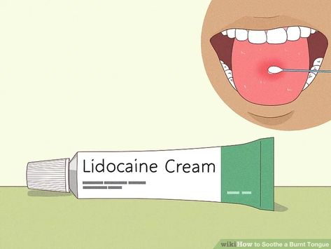 13 Ways to Soothe a Burnt Tongue - wikiHow Burnt Tongue Remedies, Burnt Tongue, Burning Tongue, Burn Remedy, Sjogrens Syndrome, Just My Luck, Numbing Cream, Plant Help, Just Pray