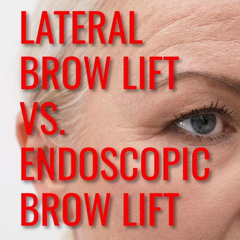 Lateral Brow Lift vs. Endoscopic Brow Lift https://charlesthornemd.com/blogs.html #cosmeticsurgery #plasticsurgery #facelift #plasticsurgeon #beauty #aesthetics #facialplasticsurgery #septorhinoplasty #surgeon #doctor #cosmetic #medical #blogging #brow #brows #eyebrows #antiaging Eyebrow Lift Before And After, Botox For Eyebrow Lift, Eyebrow Botox Lift, Lift Brows Eyebrows, Brow Lift Before And After, Eyebrow Lift Surgery, Endoscopic Brow Lift Before And After, Eyelash And Eyebrow Lift, Brow Lift Surgery