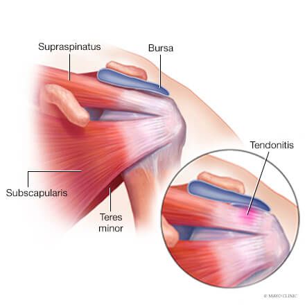 Rotator cuff tendonitis and tears - Sports Medicine Shoulder Dislocation, Rotator Cuff Tear, Rotator Cuff Injury, Frozen Shoulder, Running Program, Medical Medium, Rotator Cuff, Mayo Clinic, Sports Medicine