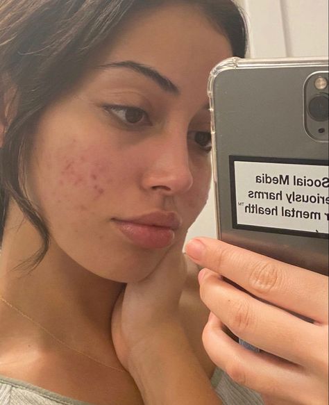 Celebrities Real Skin Texture, Girl With Acne Aesthetic, Pretty Insecurities, Celebrities With Acne, Girl With Acne, Acne Positivity, Celebrity Acne, Real Skin, Cindy Kimberly