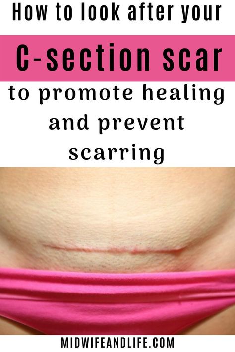 How to look after your c-section scar to promote healing and prevent scarring. C-section, caesarean, cesarean, c-section scar, wound healing, reduce scarring on c-section, looking after your c-section, can I drive after c-section, recovery rate c-section C Section Incision Healing, C Section Scar Healing, C Section Scar Massage, Cesarian Section, C Section Scar Tattoo, Scar Massage, C Section Scar, C Section Scars, C Section Recovery