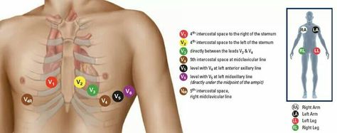 12 lead 12 Lead Ekg Placement, Ecg Placement, Ekg Placement, Lead Placement, Nursing Apps, Emt Study, Nerdy Nurse, Ekg Interpretation, Paramedic School