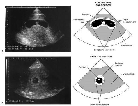 Mean Sac Diameter (MSD].   Three measurements of the gestational sac (length, depth, and width) are obtained, summed, and then divided by 3 to determine the MSD,   Gestational age (GA) (in days) is calculated by adding 30 to the MSD (in millimelers): MSD+30=GA (in days).   A, How to correctly measure the length and depth of the gestational sac on a longitudinal section,   B, How to correctly measure the width of the gestational sac on an axial section. Longitudinal Section, Medical Ultrasound, Gestational Age, Human Anatomy And Physiology, Trimesters Of Pregnancy, Anatomy And Physiology, Radiology, Human Anatomy, Ultrasound