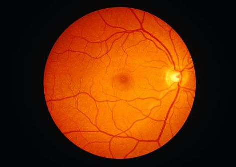 Macular telangiectasia is an eye condition that affects the macula, possibly causing loss of central vision. Eye Retina, Eye Problems, Nerve Fiber, Health Disease, Vision Loss, Eye Test, Vision Problems, Thyroid Gland, Healthy Eyes