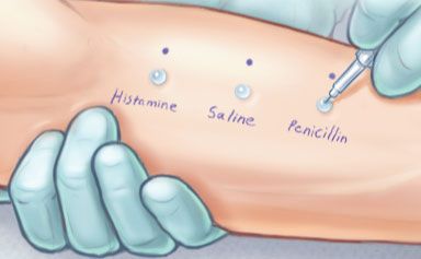 If you think you're allergic to penicillin but you're not, you may miss out on the best antibiotic to treat and prevent infection for no good reason, say specialists who advocate for more allergy testing. Penicillin Antibiotic, Allergy Testing, Allergies, Anatomy, You Think, Medical