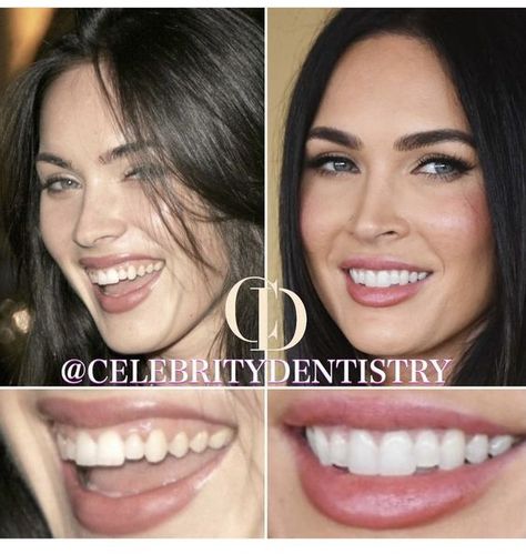 Fox Teeth, Teeth Makeover, Celebrity Teeth, Perfect Smile Teeth, Teeth Aesthetic, Dental Bonding, Veneers Teeth, Beautiful Teeth, Меган Фокс