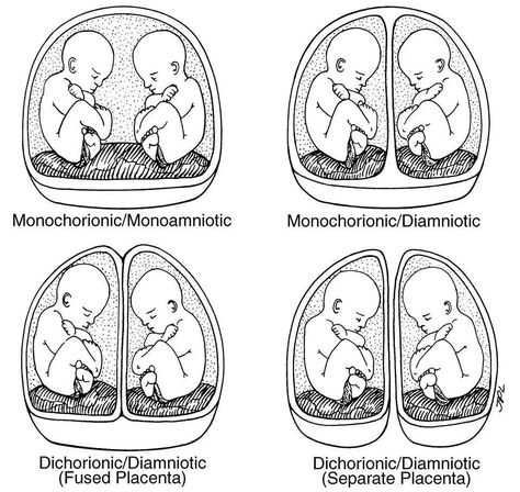 Pregnancy Ob Ultrasound, Get Pregnant With Twins, Getting Pregnant With Twins, Midwifery Student, Multiple Births, Diagnostic Medical Sonography, Pregnant With Twins, Student Midwife, Multiples Baby