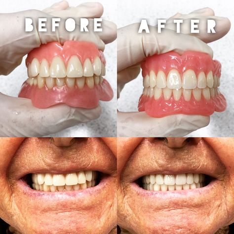 Before and after photos from a full/full case. Patient can't stop smiling - Another happy client If you've had poorly made dentures, contact us today 9317 7777 - We promise to take care of you @totaldentures #dental #fulldentures #dentureclinic #teeth #smile #dentures #totaldenturecare #reliable #makingadifference #denture #falseteeth Dentures Before And After, Dentures Before And After Immediate, Affordable Dentures, Dental Aesthetics, Natural Face Care, Dental Cavities, Dental Technician, False Teeth, Smile Teeth