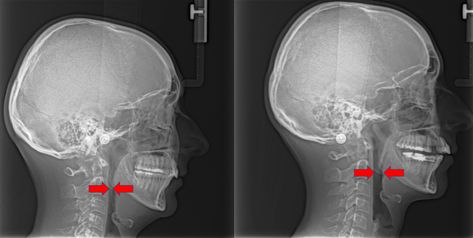 Fixed Anterior Growth Guidance Appliance (FAGGA) – Holy Grail? Gonial angle change, maxilla movement forwards and palate widening. Without surgery. – Main Forum – Correction Methods – The Great Work Community Gonial Angle, Myofunctional Therapy, Facial Bones, Types Of Facials, Teeth Braces, Muscle Imbalance, Facial Muscles, The Catch, A Miracle