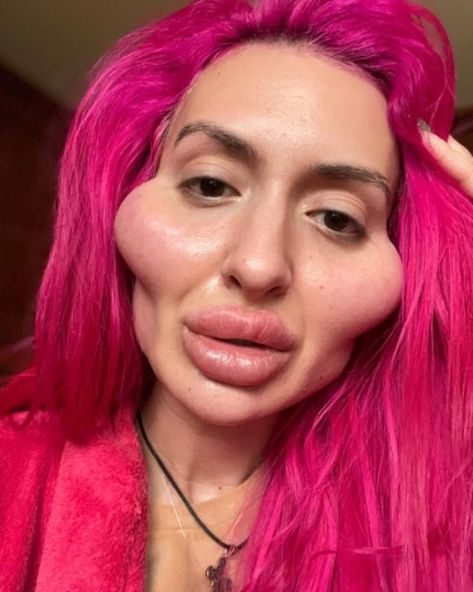 Face Injections, Big Cheeks, Funny Lips, Plastic Surgery Fail, Botox Lips, Fake Lips, Cheek Fillers, Weird Look, Alina Boz