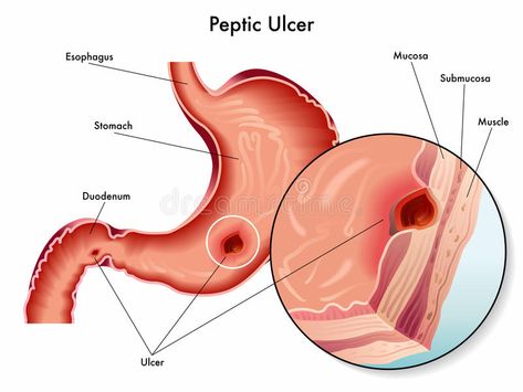 Peptic ulcer. Medical illustration of the symptoms of peptic ulcer , #sponsored, #Medical, #ulcer, #Peptic, #peptic, #symptoms #ad Stomach Ulcers Symptoms, Ulcer Symptoms, Gastric Problem, Gastric Juice, Top 10 Home Remedies, Stomach Muscles, Stomach Ulcers, Women Health Care, Stomach Acid