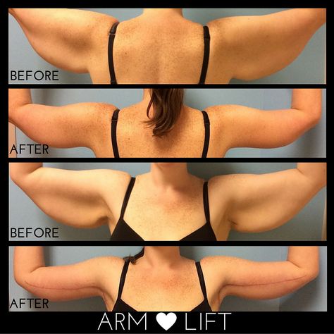 Arm lift, weight loss, Arm Lift Surgery Before And After, Back Lift Surgery, Arm Surgery, Arm Lift Surgery, Body Lift Surgery, Skin Removal Surgery, Back Lift, Plastic Fantastic, Arm Lift