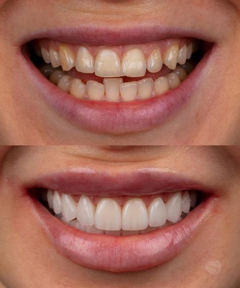 Full Mouth Rehabilitation, Teeth Correction, Dental Makeover, Loose Teeth, Dental Images, Dental Posts, Veneers Teeth, Aesthetic Dentistry, Homemade Facial Mask