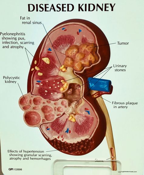 Diseased Kidney Food For Kidney Health, Polycystic Kidneys, Kidney Pain, Creatinine Levels, Kidney Detox, Too Much Estrogen, Low Estrogen, Estrogen Dominance, Kidney Health