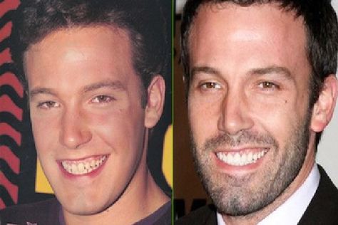 Ben There Done That-Celebrities who have fixed their teeth Celebrities With Veneers, Braces Humor, Celebrity Teeth, Dental Makeover, Celebrity Smiles, Denture Implants, Fake Teeth, Laser Teeth Whitening, Perfect Teeth