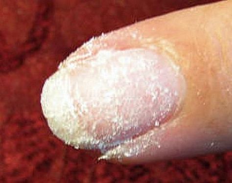 A split nail can be very painful, but there are easy ways to repair it. I have always had strong, hard nails that are the envy of most women. They are as tough as the acrylic nails women pay hundreds of dollars for. Imagine my surprise at seeing a vertical line form in one of … Split Nail Repair, Fix Broken Nail, Hair Smoothie, Nail Remedies, Grow Long Nails, Nails Women, Split Nails, Shellac Colors, Nails Care