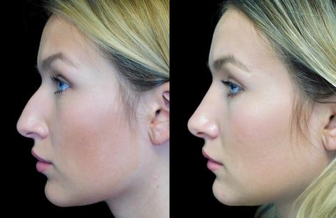 Blake Lively Nose, Bad Nose Jobs, Closed Rhinoplasty, Nose Plastic Surgery, Nose Surgery Rhinoplasty, Hooked Nose, Bulbous Nose, Nose Jobs, Rhinoplasty Nose Jobs