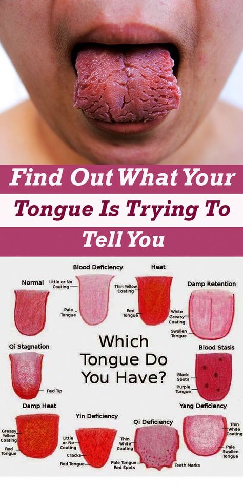 Cracked Tongue, Natural Antifungal, White Tongue, Red Tongue, Nail Fungus Remedy, Swollen Tongue, Health Signs, Tongue Health, Nail Care Tips