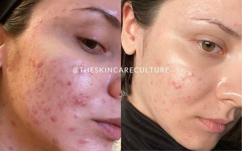 How I Healed My Cystic Acne In Five Days Clindamycin For Acne, Chin Acne, Cystic Acne Remedies, I Healed, Myo Inositol, Treating Acne, Natural Mask, Herbal Skin Care, Natural Acne Remedies