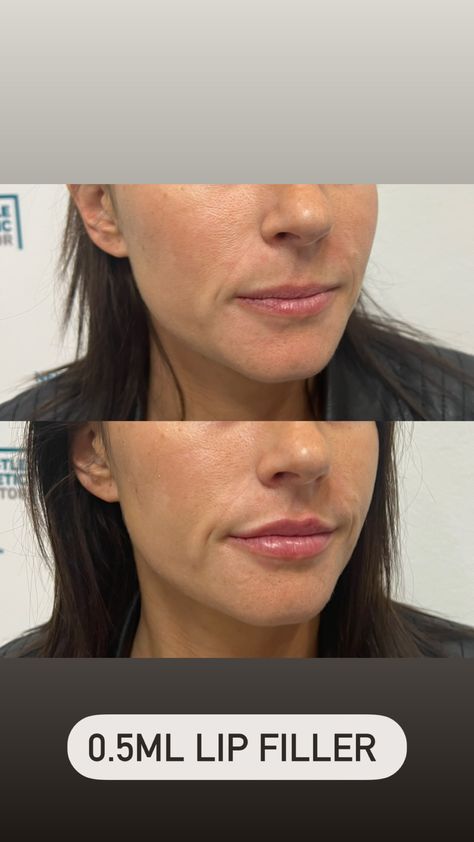 Natural Looking Lip Fillers Before And After, Small Lip Fillers Before And After, Lip Flip Vs Filler, Natural Lip Fillers Before And After, Upper Lip Filler, .5 Lip Filler, Half Syringe Lip Filler Before And After, Natural Lip Fillers 0.5ml, Top Lip Filler