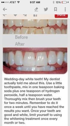 Whiten Teeth With Baking Soda, Baking Soda Teeth, Baking Soda Teeth Whitening, Nyttige Tips, Teeth Whitening Homemade, Teeth Whitening Remedies, Teeth Whitening Diy, Charcoal Teeth Whitening, Whiten Teeth