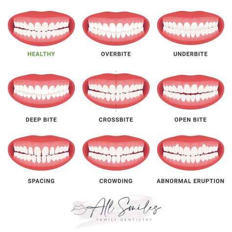 Types Of Mouth, Straighten Teeth Without Braces, Perfect Smile Teeth, Teeth Correction, Teeth Problems, Dental Animation, Braces Pain, Myofunctional Therapy, Braces Tips