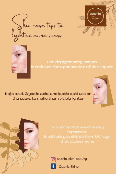 beauty tips | taking care of your skin | treat your acne | lighten scars because of acne Stubborn Acne, Kojic Acid, Acne Marks, Lactic Acid, Glycolic Acid, Skin Tips, The Spot, Dark Spots, Uv Rays