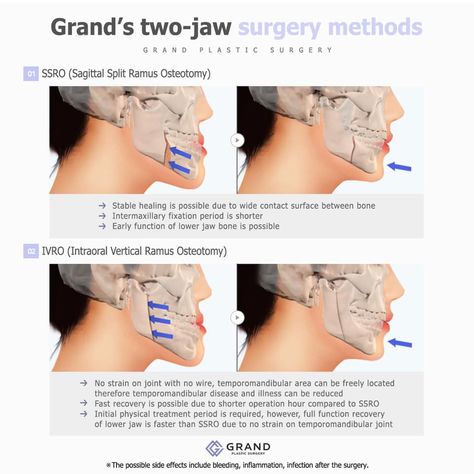 Jaw surgery involves moving the lower and upper jaw to create a splendidly balanced facial line. A smooth and refined jawline, creates more harmonious and equal facial features. For online consultation🎀 Tel: (+82) 70-7119-1580 Mobile: (+82) 10-9132-6546 (Whatsapp, Line, Kakaotalk, Viber, iMessage) Email: grandps.en@gmail.com Facebook: Grand Plastic Surgery, Korea Website: eng.grandsurgery.com Pinterest : https://www.pinterest.co.kr/grandps_eng/ Tumblr: http://grandsurgery.tumblr.com/ Instagram: Plastic Surgery Korea, Jaw Surgery, Online Consultation, Jaw Bone, Ice Coffee, Facial Features, Anatomy Reference, Health Advice, Plastic Surgery