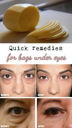 Tuesday's Tip - Natural Solutions to Get Rid of Under-Eye Bags, Dark Circles or Eye Puffiness Puffy Eyes Remedy, Puffy Eye, Bags Under Eyes, Remove Dark Circles, Under Eyes, Dark Circles Under Eyes, Dark Circle, Under Eye Bags, Puffy Eyes