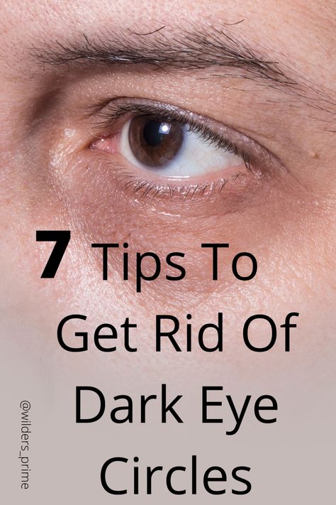 Learn all about dark circles under your eyes. Discover how to lessen their appearance or get rid of them permanently. Black Undereye, How To Get Rid Of Dark Circles Under Eye, Dark Rings Under Eyes, Dark Under Eye Circles, Dark Rings, Skin Massage, Dark Eye Circles, Brown Spots Removal, Under Eye Puffiness