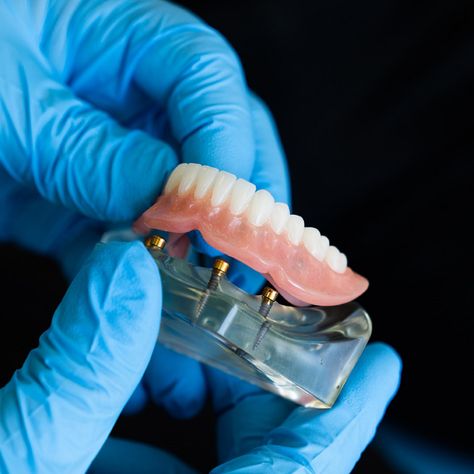 Discover the superior quality of All-on-4 dental implants crafted in our state-of-the-art dental lab! Your patients can enjoy unmatched stability, functionality, and aesthetics, all while benefiting from the precision and care of our dedicated dental technicians.   #ReliableDentalLab #DentalLab #DentalImplants #AllOnFour #FullArch Dental Images, Dental Technician, Dental Emergency, Implant Dentistry, Dental Laboratory, Emergency Dentist, Dental Cosmetics, Dental Procedures, Dental Lab