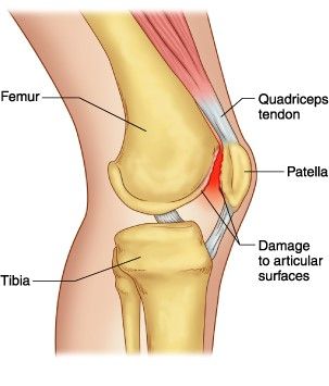 Image source: http://www.mdguidelines.com/patella-chondromalacia Runners Knee Pain, Common Knee Injuries, Parts Of The Knee, Patellofemoral Pain Syndrome, Swollen Knee, Runners Knee, Knee Pain Exercises, Knee Exercises, Knee Pain Relief