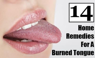 14 Home Remedies for Burning Tongue Burnt Tongue Remedies, Burnt Tongue, Burning Tongue, Tongue Sores, Burn Remedy, Remedies For Dry Mouth, Mouth Health, Tongue Health, Top Diy