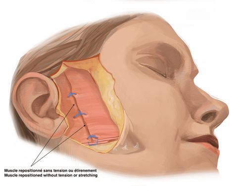 Deep Plane Facelift Before And After, Face Ratio, Facelift Recovery, Medical Essentials, Deep Plane Facelift, Change Appearance, Facelift Before And After, Facelift Procedure, Non Surgical Facelift