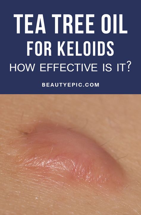 Wounds are usually surrounded by scar tissues and overgrowth of scar tissues is known as keloid. Here we shall discuss its using of tea tree oil for keloids Tea Tree Oil Benefits, Body Improvement, Tea Tree Oil Uses, Scar Remedies, Tea Tree Oil Face, Oils For Scars, Tea Tree Oil For Acne, Cold Sores Remedies, Natural Cold Remedies