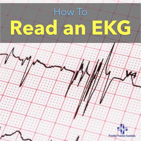 Blood Vessels Anatomy, Ekg Rhythms, St Elevation, Rotator Cuff Surgery, Normal Sinus Rhythm, Cardiac Cycle, Pr Interval, Cardiac Rhythms, Squiggly Lines