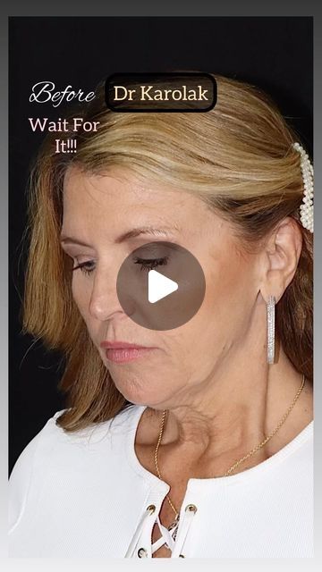 Dr. Mark Karolak, DO, FAOCO on Instagram: "This #gorgeous 59 year old patient came to visit me in New Jersey from Tennessee. I used my deep plane facelift and neck lift technique to highlight her natural beauty!!! I love that her results look elegant and complimentary to her features. The temporal lift helped balance her face by tightening the temple area, upper part of the cheek, and outside portion of her brows. I am so grateful that she let me share her photos! I absolutely love her results, and so does she!!! 

There’s a fine line between too much and not enough. The goal is to look better, not different.

#deepplanefacelift #facelift  #plasticsurgery #drkarolak #bestfacelift #verticalfacelift #newjersey #monmouthcounty #faceliftbeforeandafter #newyorkcity #nj #faceliftbeforeandafterpi Deep Plane Facelift Before And After, Deep Plane Facelift, Facelift Before And After, Cheek Lift, Face Lift Surgery, Neck Lift, I Am So Grateful, So Grateful, Fine Line