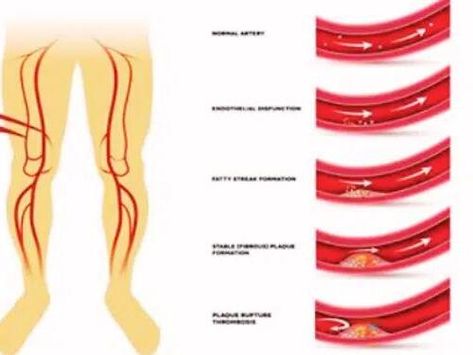 How To Unclog Arteries Naturally, Unclog Arteries, Clean Arteries, Cholesterol Foods, Detox Your Liver, Clogged Arteries, Swollen Legs, Mens Journal, Fiber Rich Foods