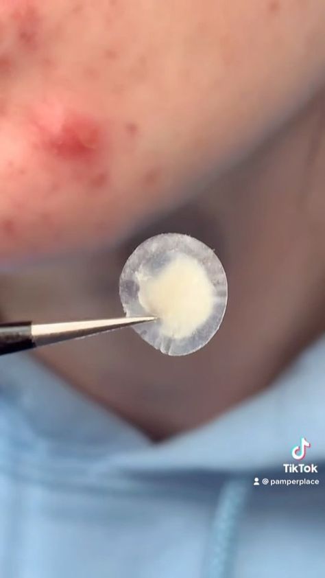 thepamperplace on Instagram: SATISFYING pimple patch video! The hero cosmetics invisible patch Pimple Patch Removal, Pimple Patches, Pimple Patch, Skin Care Tips, Skin Care Routine, Skin Care, On Instagram, Quick Saves, Instagram