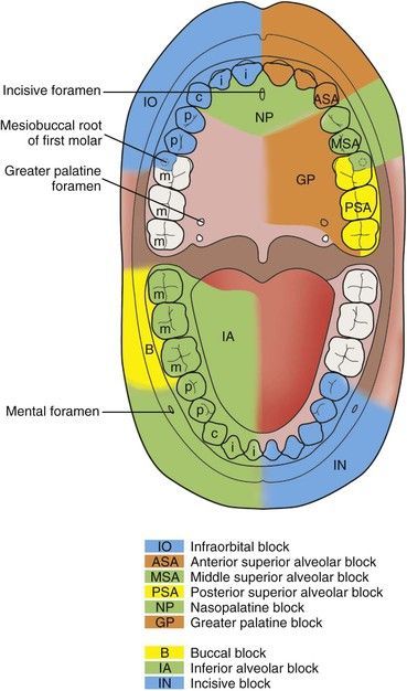 Dental Anesthesia, Dental Assistant School, Dental Hygienist School, Local Anesthesia, Dental Assistant Study, Registered Dental Hygienist, Dental Hygiene Student, Dental Assisting, Dental World