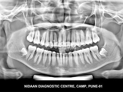 Looking for a Dental X-Ray Centre in Pune? Nidaan Dental Imaging is one of the recognized center offering Cone Beam CT, Dental CT and Dental X-ray and OPG services at an affordable rate. The center is equipped with advanced facilities and has a friendly staff and renowned radiologists to perform dental imaging. Dental Xrays Tips, Cbct Dental, How To Read Dental Xrays, Dental Xray Positioning, Dental Impression Material, Dental Panoramic X Rays, Dental Impressions, Open Dental Software, Dental Posters