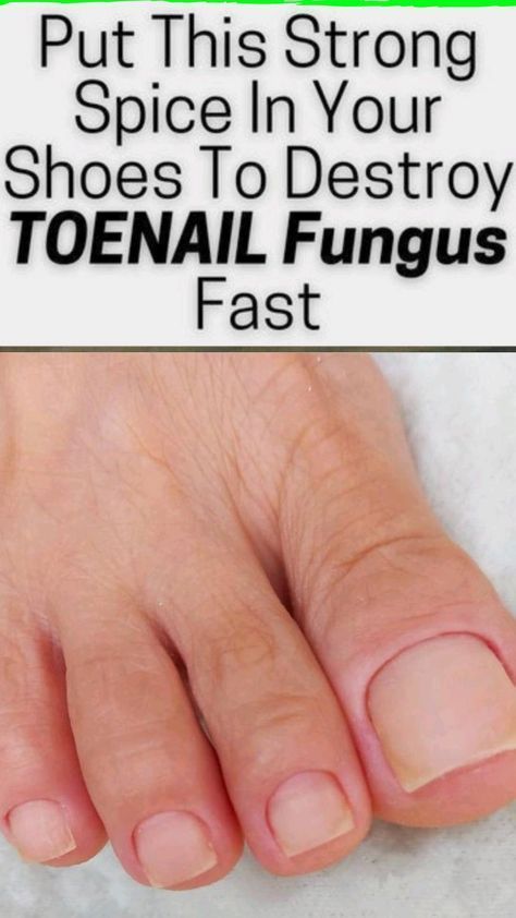 Home remedy to remove all types of nail fungus infection!#fungusproblem #killsnail #treatmentfungus #nailfungus #toenailfungus #fungus Infected Toenail, Toenail Fungal Infection, Fingernail Fungus, Nail Remedies, Nail Fungus Remedy, Toenail Fungus Remedies, Nail Infection, Fungal Nail, Nail Care Routine