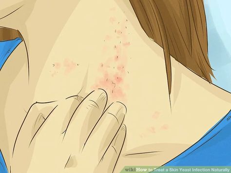 Yeast Infection Pictures, Skin Irritation Remedies, Yeast Infection On Skin, Fungal Infection Remedies, Fungal Infection Skin, Red Rash, Skin Hacks, Candida Recipes, Yeast Infections