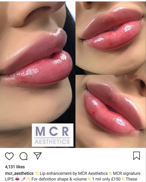 Sausage lips Bad Lip Injections, Lip Fillers Juvederm, Lips Inspiration, Botox Lips, Fake Lips, Facial Fillers, Facial Contouring, Black Acrylic Nails, Lip Filler