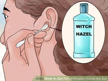 Hydrogen Peroxide Skin, Ear Pimple, Pimples On Buttocks, Pimples On Forehead, Witch Hazel For Skin, Inside Ear, Blind Pimple, Home Remedies For Pimples, Pimples Under The Skin