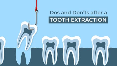 do's and don'ts after a tooth extraction