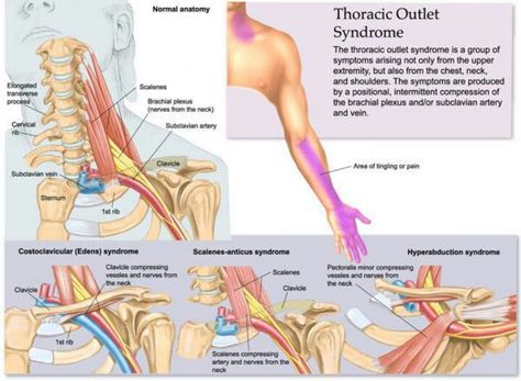 Thoracic outlet syndrome Thoracic Outlet, Massage Marketing, Physical Therapist Assistant, Hand Therapy, Massage Techniques, Nerve Pain, Anatomy And Physiology, Massage Therapist, Chiropractic