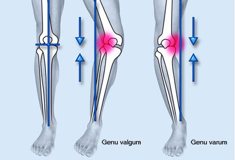 Exercises to prevent knee osteoarthritis - All topics relating to ... Leg Surgery, Best Acne Scar Removal, Bow Legged Correction, Different Types Of Acne, Knock Knees, Back Acne, Bow Legged, Knee Replacement Surgery, Leg Braces